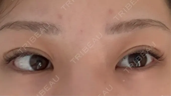 二重埋没 / 目元修正 水の森美容クリニック 東京渋谷院 DAY 37 メイン用