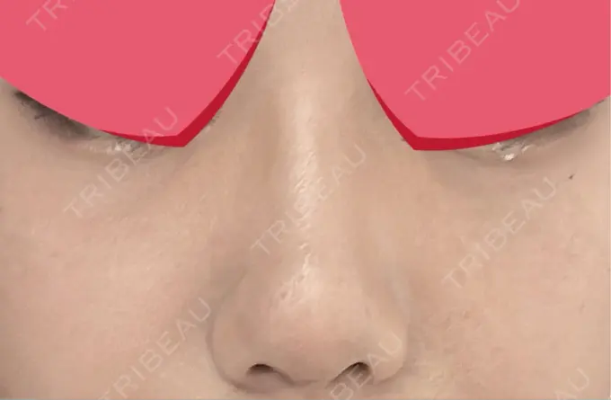 鼻尖形成（切開） / 下まぶたの脂肪取り / 真皮移植 LUHO（ルホ）美容外科 DAY 30 メイン用