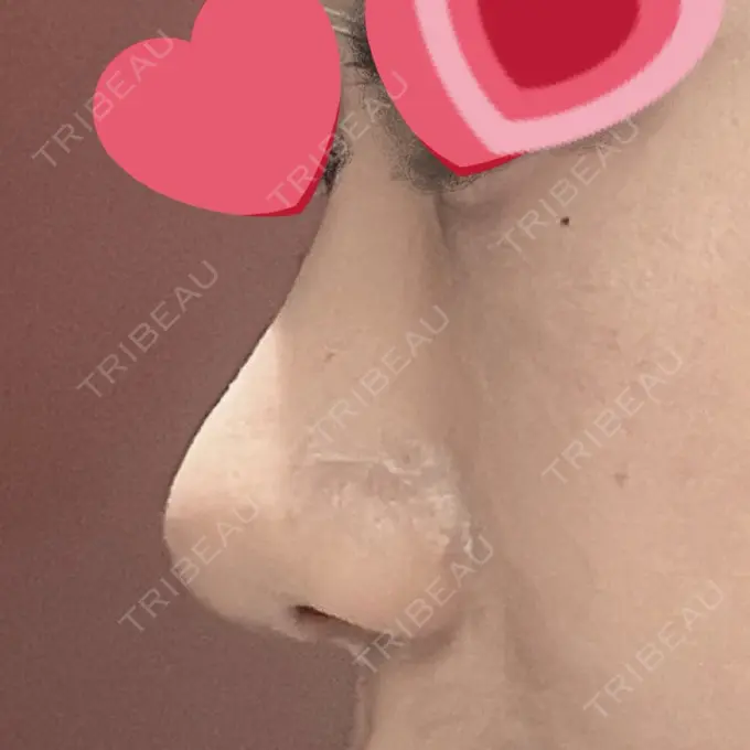 鼻尖形成（切開） / 下まぶたの脂肪取り / 真皮移植 LUHO（ルホ）美容外科 DAY 30 メイン用