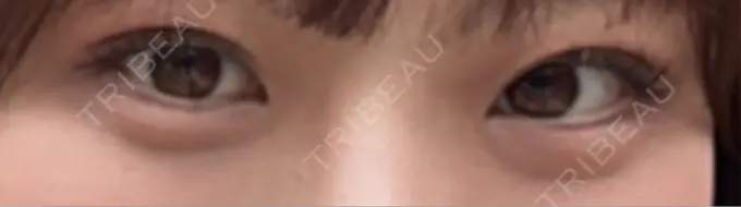 二重埋没 / 目元修正 水の森美容クリニック 東京渋谷院 DAY 30 メイン用