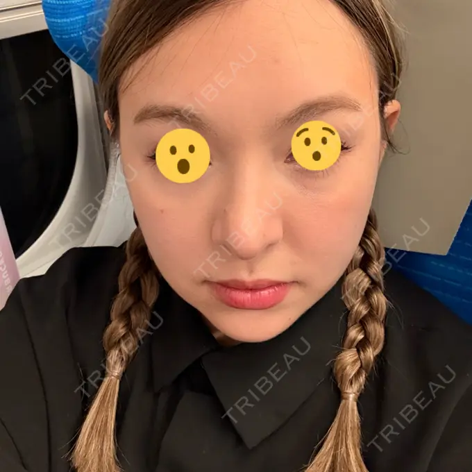 糸リフト / ヒアルロン酸注入（目の下） / RF（高周波）たるみ治療 gift clinic AFTER メイン用