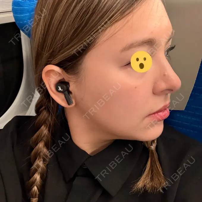 糸リフト / ヒアルロン酸注入（目の下） / RF（高周波）たるみ治療 gift clinic DAY 23 メイン用