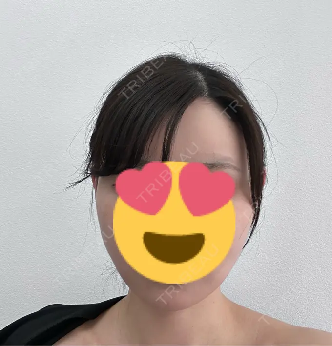 糸リフト / 脂肪吸引（顔） Mods Clinic（モッズクリニック） 名古屋院 DAY 32 メイン用