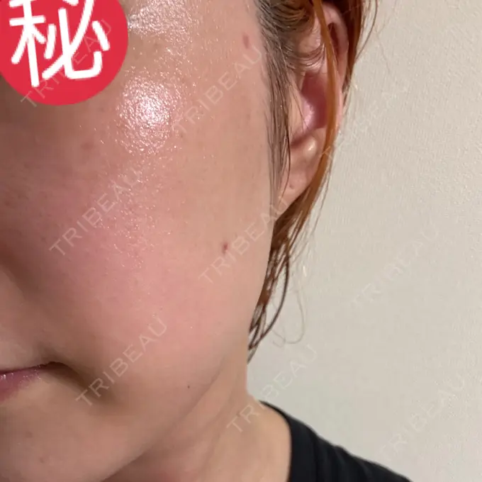 ほくろ・いぼ除去レーザー（肌） Mavie Beauty Clinic （マヴィービューティークリニック） DAY 23 メイン用