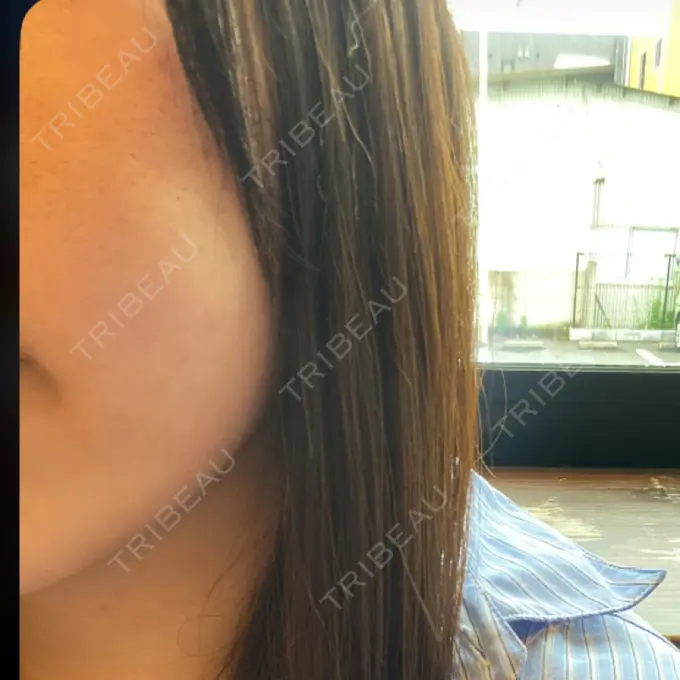 肌ヒアルロン酸注入（たるみ・シワ改善） / サブシジョン / ピコレーザートーニング（美白・肝斑） 東京シルククリニック 東京神田院 DAY 6 メイン用