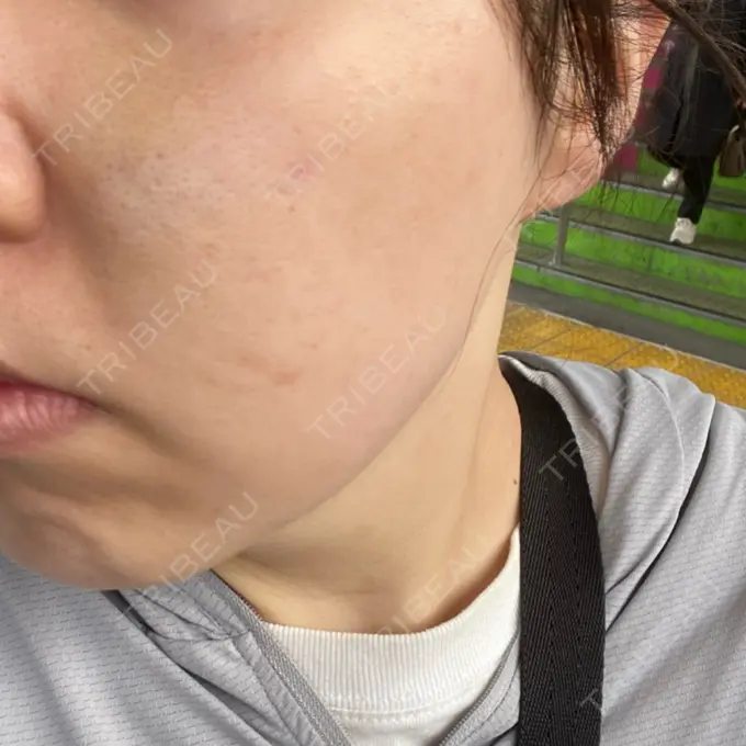 肌ヒアルロン酸注入（たるみ・シワ改善） / サブシジョン / ピコレーザートーニング（美白・肝斑） 東京シルククリニック 東京神田院 DAY 7 メイン用