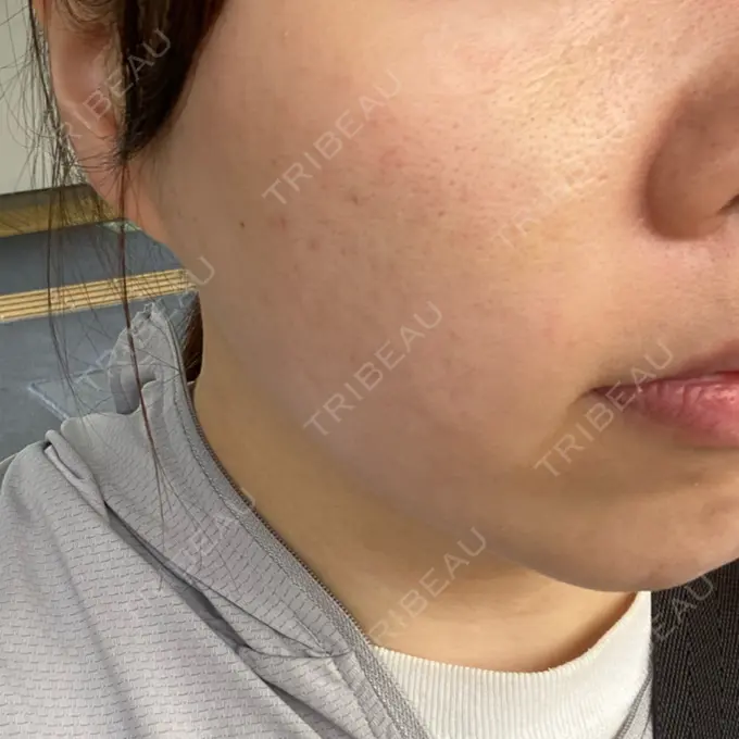 肌ヒアルロン酸注入（たるみ・シワ改善） / サブシジョン / ピコレーザートーニング（美白・肝斑） 東京シルククリニック 東京神田院 DAY 7 メイン用