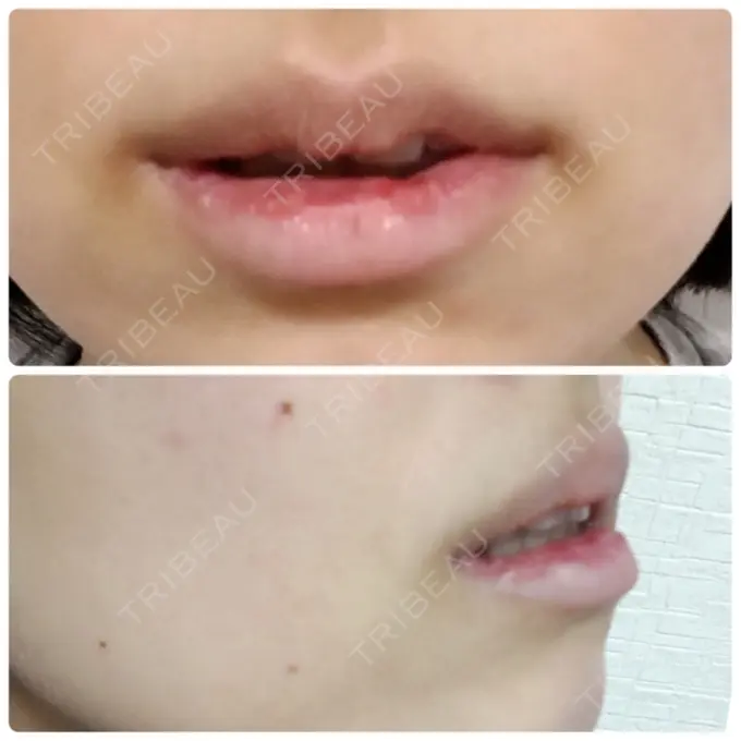 口唇縮小術 品川スキンクリニック表参道院 DAY 14 メイン用