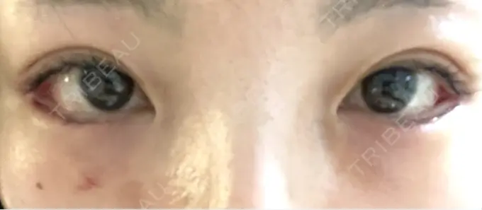 タレ目形成・グラマラスライン（切開） アリエル美容クリニック 横浜院 DAY 21 メイン用