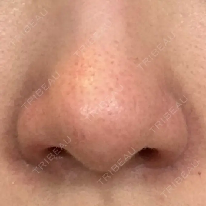 鼻孔縁挙上 シエルクリニック DAY 30 メイン用