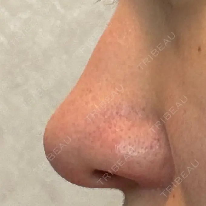 鼻孔縁挙上 シエルクリニック DAY 30 メイン用