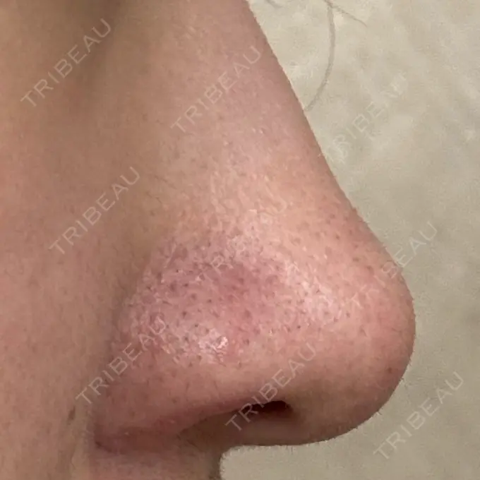 鼻孔縁挙上 シエルクリニック DAY 30 メイン用