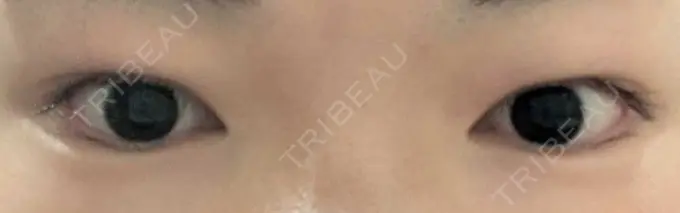 二重埋没 聖心美容クリニック 六本木院 DAY 10 メイン用