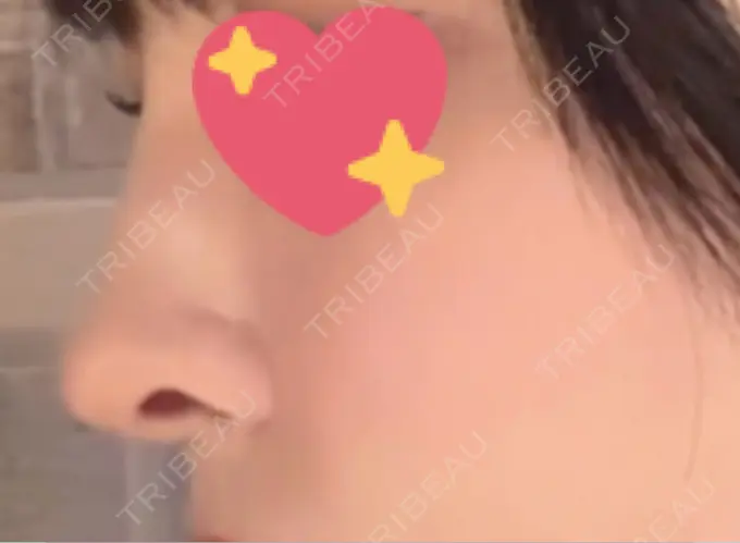 軟骨移植 吉祥寺アイビークリニック DAY 30 メイン用