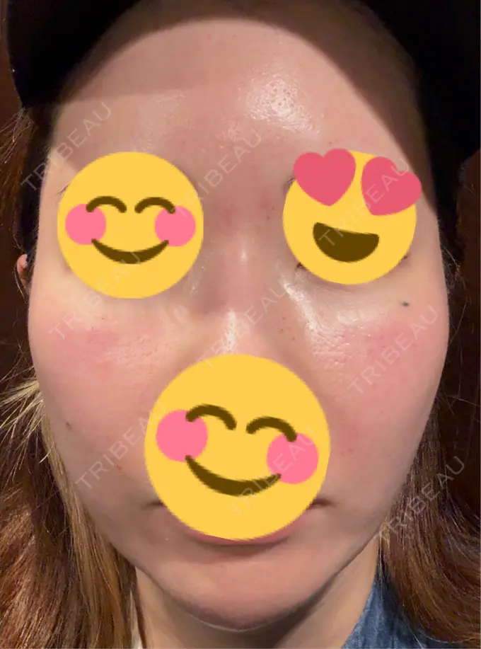 水光注射（ハリ・美肌） / PRP皮膚再生療法 筋肉・美容クリニック AFTER メイン用