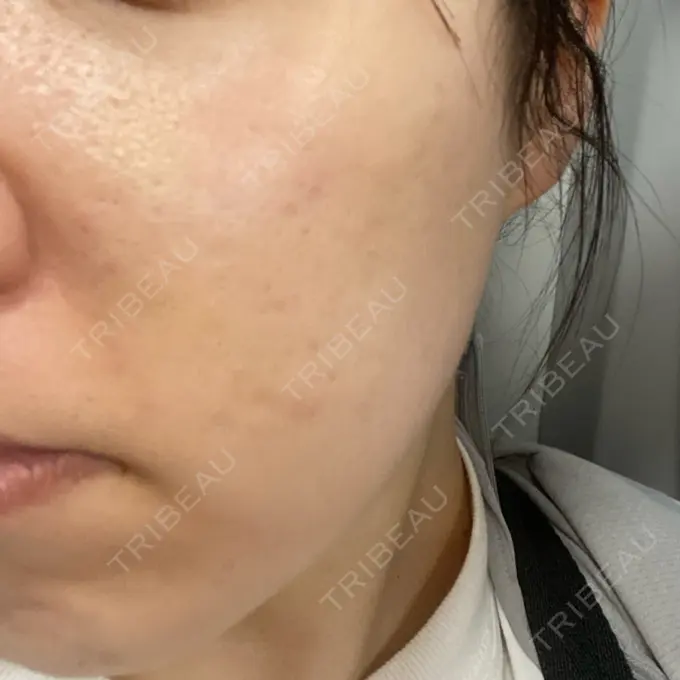 肌ヒアルロン酸注入（たるみ・シワ改善） / サブシジョン / ピコレーザートーニング（美白・肝斑） 東京シルククリニック 東京神田院 DAY 8 メイン用