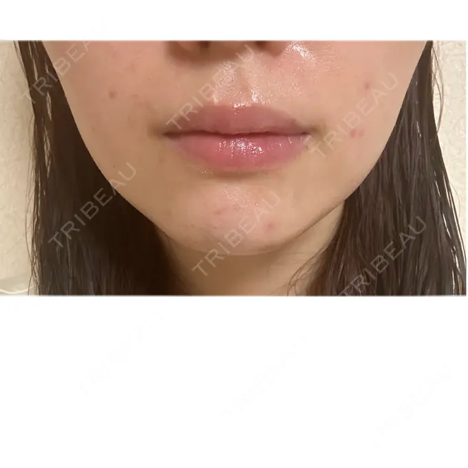 ニードルRF（ポテンツァなど） / アグネス 日本ウェルネス再生クリニック DAY 8 メイン用