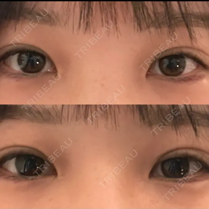 ヒアルロン酸注入（涙袋） AZ BEAUTY CLINIC DAY 0 メイン用