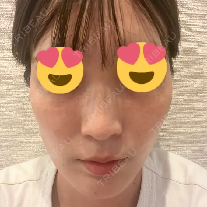 水光注射（ハリ・美肌） 筋肉・美容クリニック AFTER メイン用