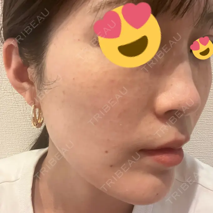 水光注射（ハリ・美肌） 筋肉・美容クリニック DAY 0 メイン用