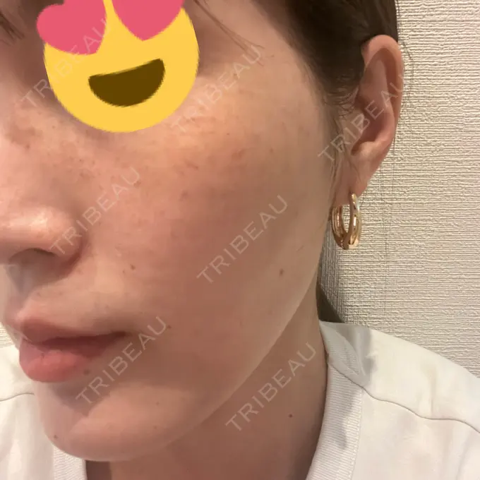 水光注射（ハリ・美肌） 筋肉・美容クリニック DAY 0 メイン用