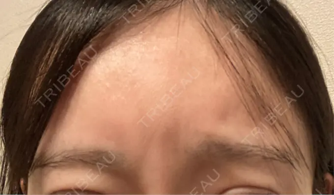 ボトックス（眉間） レナトゥスクリニック 東京田町院 DAY 27 メイン用