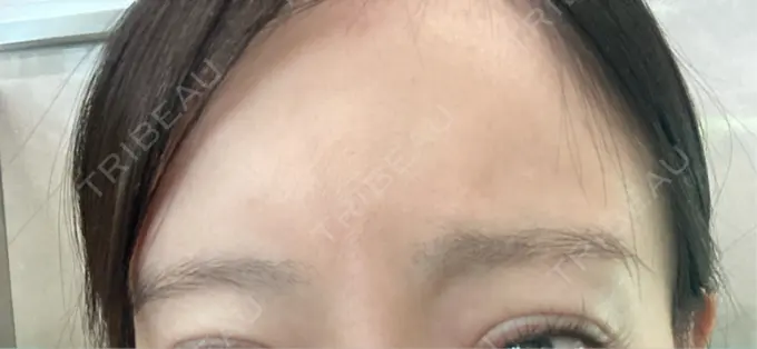 ボトックス（眉間） レナトゥスクリニック 東京田町院 DAY 8 メイン用