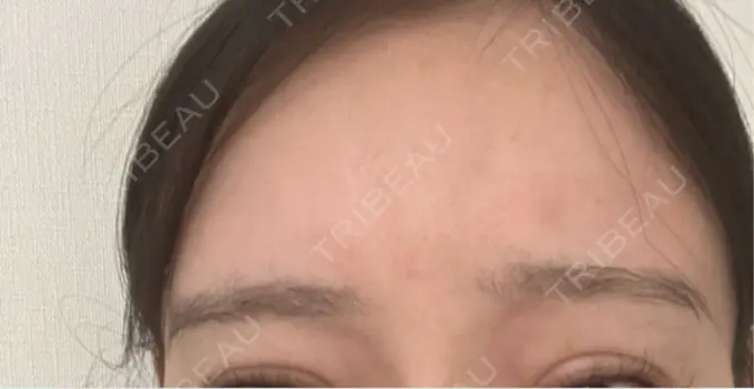 ボトックス（眉間） レナトゥスクリニック 東京田町院 DAY 33 メイン用