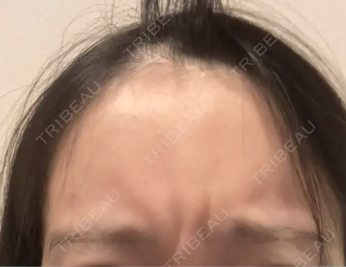 ボトックス（眉間） レナトゥスクリニック 東京田町院 DAY 93 メイン用