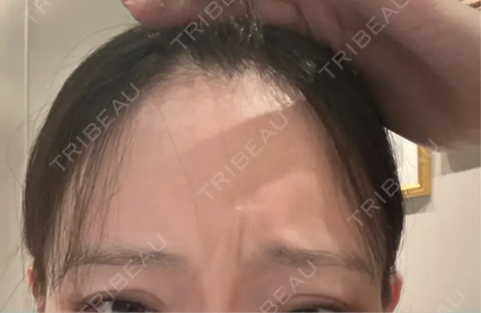 ボトックス（眉間） レナトゥスクリニック 東京田町院 AFTER メイン用