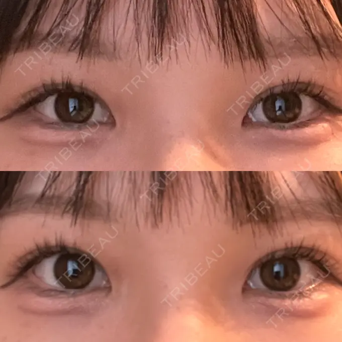 ヒアルロン酸注入（涙袋） AZ BEAUTY CLINIC DAY 0 メイン用