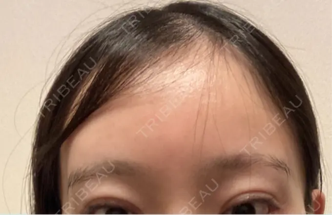 ボトックス（眉間） レナトゥスクリニック 東京田町院 DAY 58 メイン用