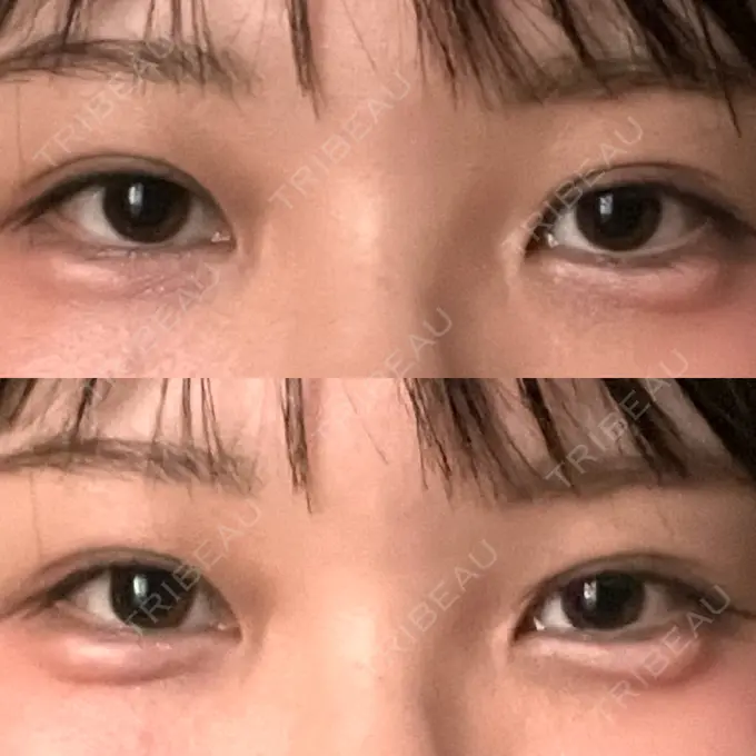 ヒアルロン酸注入（涙袋） AZ BEAUTY CLINIC AFTER メイン用