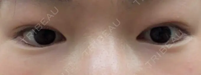 二重埋没 聖心美容クリニック 六本木院 DAY 13 メイン用