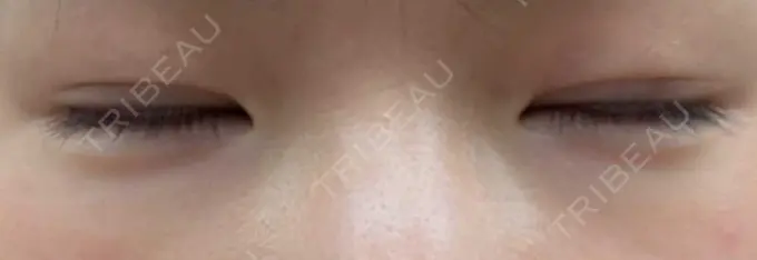 二重埋没 聖心美容クリニック 六本木院 AFTER メイン用