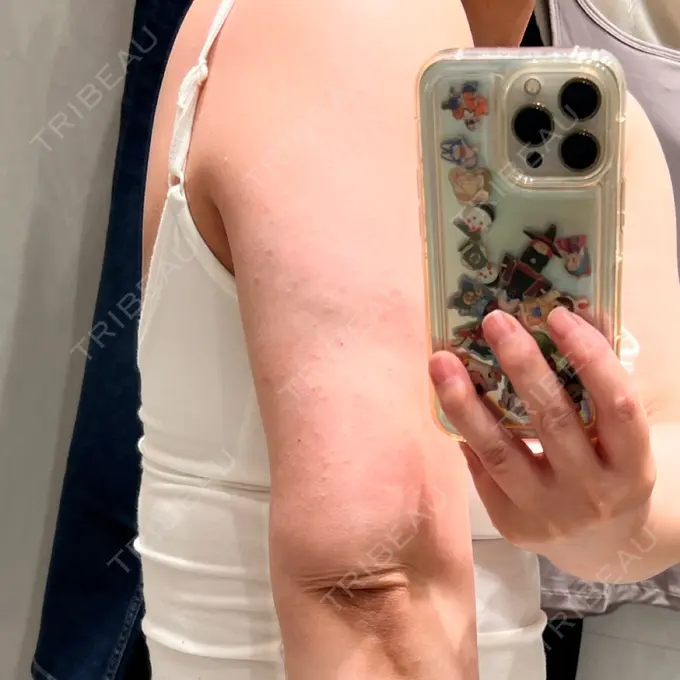 脂肪溶解注射（二の腕） Natural Skin Clinic 笹塚院 DAY 0 メイン用