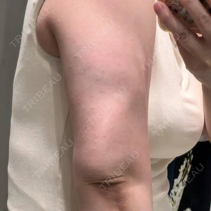 脂肪溶解注射（二の腕） Natural Skin Clinic 笹塚院 DAY 0 メイン用