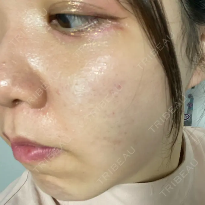 肌ヒアルロン酸注入（たるみ・シワ改善） / サブシジョン / ピコレーザートーニング（美白・肝斑） 東京シルククリニック 東京神田院 DAY 10 メイン用