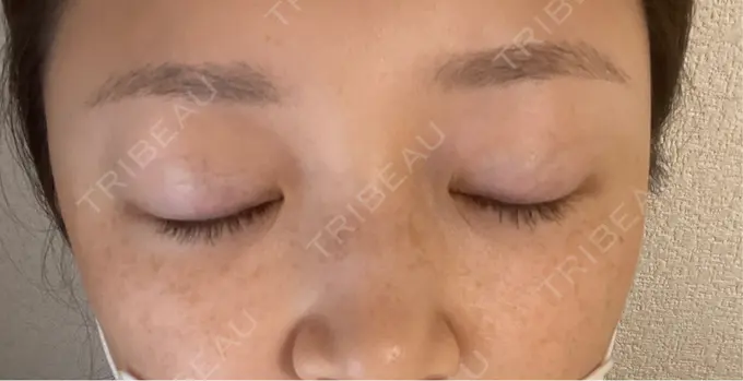 光治療（フォトフェイシャルなど） 城本クリニック 大宮院 AFTER メイン用