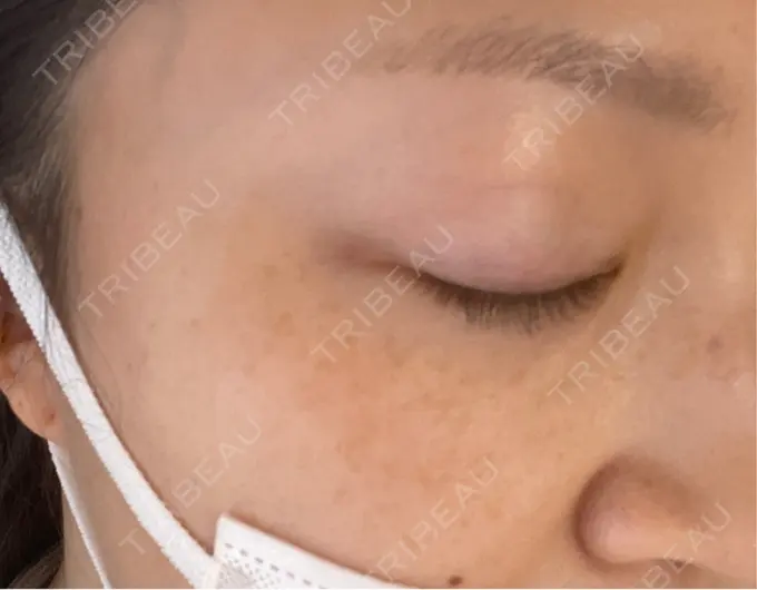 光治療（フォトフェイシャルなど） 城本クリニック 大宮院 DAY 23 メイン用