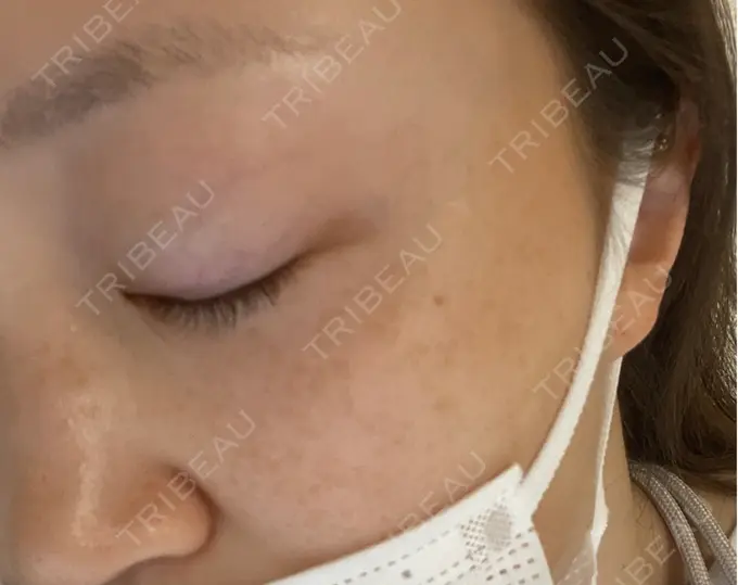 光治療（フォトフェイシャルなど） 城本クリニック 大宮院 DAY 23 メイン用