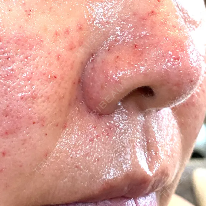 サブシジョン / 肌育注射（ジュベルックなど） / その他（肌） ゆきスキンクリニック 東池袋 DAY 0 メイン用