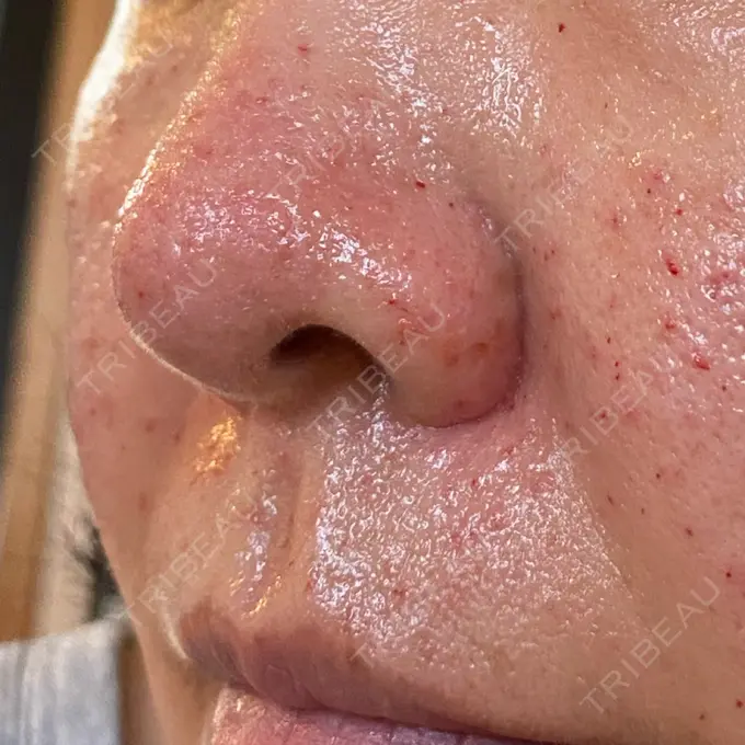 サブシジョン / 肌育注射（ジュベルックなど） / その他（肌） ゆきスキンクリニック 東池袋 DAY 0 メイン用