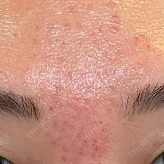 サブシジョン / 肌育注射（ジュベルックなど） / その他（肌） ゆきスキンクリニック 東池袋 DAY 0 メイン用