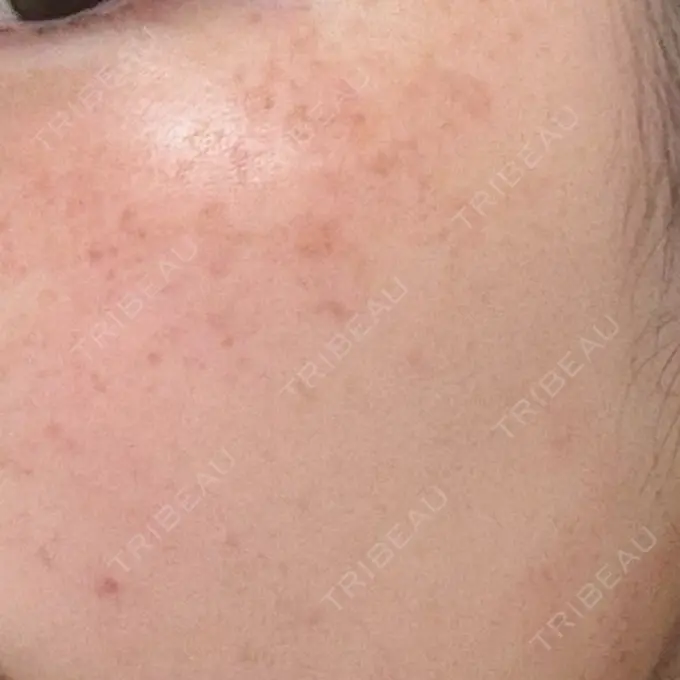 ピコフラクショナルレーザー（毛穴・ニキビ跡） 麹町皮ふ科・形成外科クリニック DAY 2 メイン用