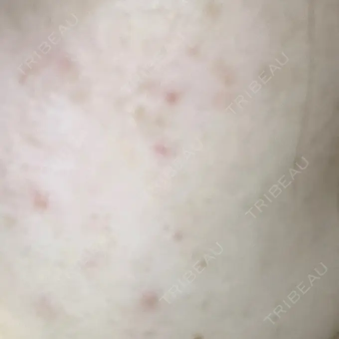 イオン導入 城本クリニック 名古屋院 DAY 0 メイン用