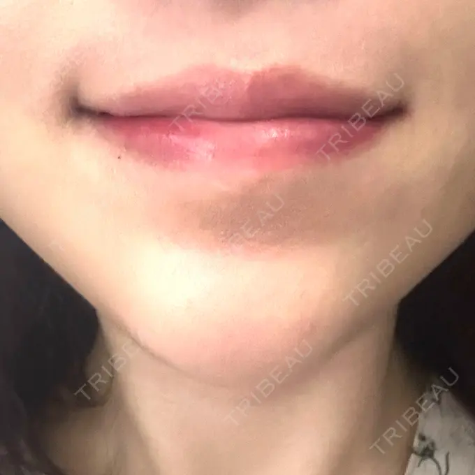 ボトックス（エラ・小顔） / その他 eクリニック 岡山院 AFTER メイン用