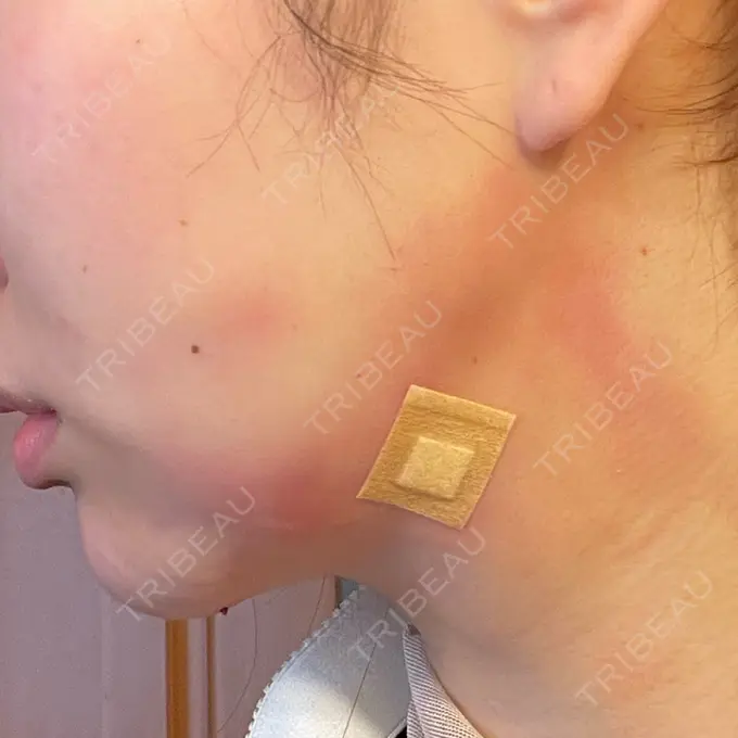 脂肪吸引（顔） / ジョールファット除去 / ボトックス（エラ・小顔） アリエル美容クリニック 大宮院 DAY 1 メイン用