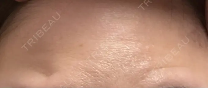 ボトックス（額） TCB東京中央美容外科 横浜駅前院 DAY 2 メイン用