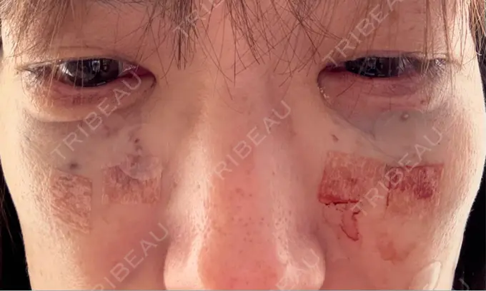 糸リフト / クマ治療 / ほくろ・いぼ除去レーザー（肌） あいちビューティークリニック栄本院 AFTER メイン用